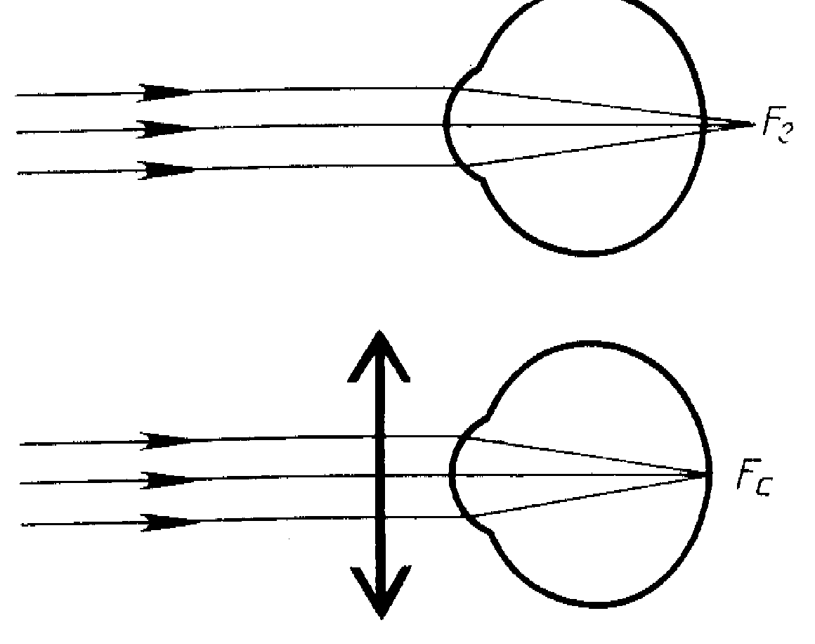Глаз очки дальнозоркость и близорукость. Дальнозоркость схема физика. Зрение схема близорукость и дальнозоркость. Близорукость и дальнозоркость схема физика. Нормальное зрение близорукость дальнозоркость схема.